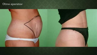 Otros aparatos:
Piel y mucosas: desaparece la hiperpigmentación cutánea, las estrías pasan de un
color rojizo a un tinte nacarado definitivo, desaparecen los hematomas
suconjutivales, las petequias y las hemorragias capilares originadas por los pujos.
· Tejido mioconjuntivo: la pared abdominal presenta un estado de flacidez, los
músculos rectos del abdomen experimentan distintos grados de diástasis, si la
separación llega hasta la sinfisis pubiana, la misma se considera definitiva.
· Aparato urinario: la vejiga y la uretra se desematizan facilitando la micción,
pero en ocaciones la hiperdistensión de la musculatura pelviana, las lesiones
vesicales y la relajación vesical pos parto, pueden inhibir el reflejo miccional
favoreciendo la retención urinaria, estos hechos desaparecen al final de este
período.
 