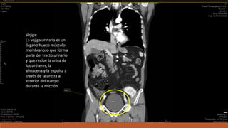 Vejiga:
La vejiga urinaria es un
órgano hueco músculo-
membranoso que forma
parte del tracto urinario
y que recibe la orina de
los uréteres, la
almacena y la expulsa a
través de la uretra al
exterior del cuerpo
durante la micción.
 