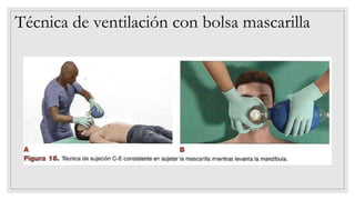 Técnica de ventilación con bolsa mascarilla
 