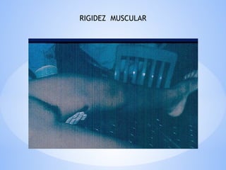 RIGIDEZ MUSCULAR
 