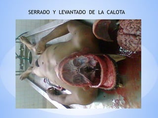 SERRADO Y LEVANTADO DE LA CALOTA
 