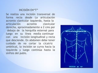 INCISIÓN EN“T”
Se realiza una incisión transversal de
forma recta desde La articulación
acromio clavicular izquierda, hasta la
articulación acromio clavicular
derecha, aproximadamente a 2 cms por
debajo de la horquilla esternal para
luego en su línea media continuar
con una incisión longitudinal y recta
que desciende. En abdomen debe tener
cuidado de no cortar la cicatriz
umbilical, la incisión se curva hacia la
izquierda y luego continúa hasta la
sínfisis del pubis.
 