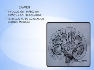 EXAMEN
*INFLAMACIÓN , INFECCIÓN,
TUMOR, CICATRIZ,CALCULOS
*PERDIDA O NO DE LA RELACION
CORTICO-MEDULAR
 