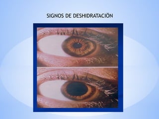 SIGNOS DE DESHIDRATACIÖN
 