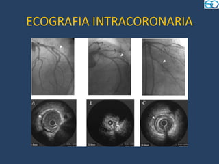 ECOGRAFIA INTRACORONARIA
 