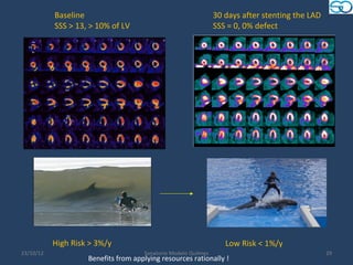 Baseline                                             30 days after stenting the LAD
           SSS > 13, > 10% of LV                                SSS = 0, 0% defect




           High Risk > 3%/y                                        Low Risk < 1%/y
23/10/12                             Sanatorio Modelo Quilmes                                    29
                    Benefits from applying resources rationally !
 