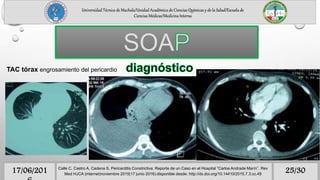 Universidad Técnica de Machala/Unidad Académica de Ciencias Químicas y de la Salud/Escuela de
Ciencias Médicas/Medicina Interna
25/3017/06/201 Calle C, Castro A, Cadena S. Pericarditis Constrictiva: Reporte de un Caso en el Hospital “Carlos Andrade Marín”. Rev
Med HJCA (internet)noviembre 2015(17 junio 2016).disponible desde: http://dx.doi.org/10.14410/2015.7.3.cc.49
SOA
TAC tórax engrosamiento del pericardio
 