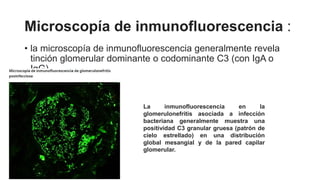 Microscopía de inmunofluorescencia :
• la microscopía de inmunofluorescencia generalmente revela
tinción glomerular dominante o codominante C3 (con IgA o
IgG).
La inmunofluorescencia en la
glomerulonefritis asociada a infección
bacteriana generalmente muestra una
positividad C3 granular gruesa (patrón de
cielo estrellado) en una distribución
global mesangial y de la pared capilar
glomerular.
 