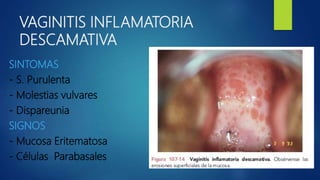 VAGINITIS INFLAMATORIA
DESCAMATIVA
SINTOMAS
- S. Purulenta
- Molestias vulvares
- Dispareunia
SIGNOS
- Mucosa Eritematosa
- Células Parabasales
 