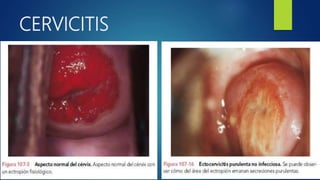 CERVICITIS
 