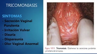 TRICOMONIASIS
SINTOMAS
- Secreción Vaginal
Purulenta
- Irritación Vulvar
- Disuria
- Dispareunia
- Olor Vaginal Anormal
 