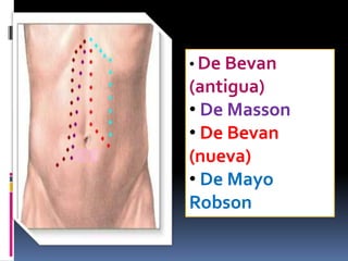 • De Bevan

(antigua)
• De Masson
• De Bevan
(nueva)
• De Mayo
Robson

 