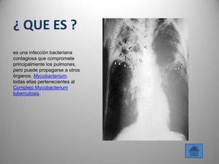¿ QUE ES ?
es una infección bacteriana
contagiosa que compromete
principalmente los pulmones,
pero puede propagarse a otros
órganos. Mycobacterium,
todas ellas pertenecientes al
Complejo Mycobacterium
tuberculosis.
 