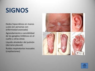 SIGNOS
Dedos hipocráticos en manos
y pies (en personas con
enfermedad avanzada)
Agrandamiento o sensibilidad
de los ganglios linfáticos en el
cuello u otras áreas
Líquido alrededor del pulmón
(derrame pleural)
Ruidos respiratorios inusuales
(crepitaciones)
 