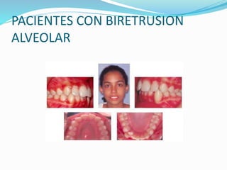 PACIENTES CON BIRETRUSION
ALVEOLAR
 