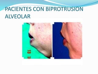 PACIENTES CON BIPROTRUSION
ALVEOLAR
 