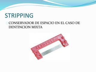 STRIPPING
CONSERVADOR DE ESPACIO EN EL CASO DE
DENTINCION MIXTA
 