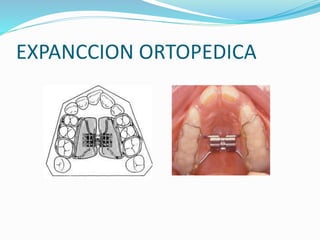 EXPANCCION ORTOPEDICA
 