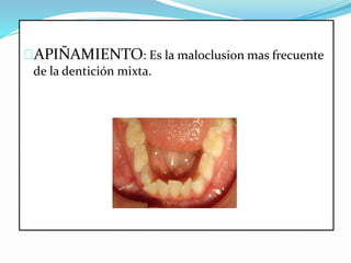 APIÑAMIENTO: Es la maloclusion mas frecuente
de la dentición mixta.
 