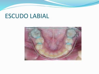 ESCUDO LABIAL
 