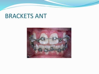 BRACKETS ANT
 