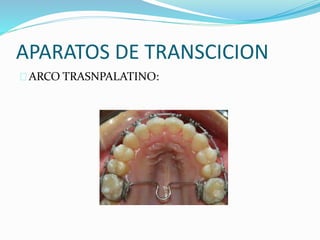 APARATOS DE TRANSCICION
ARCO TRASNPALATINO:
 