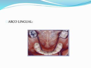ARCO LINGUAL:
 