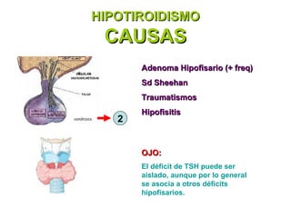 HIPOTIROIDISMO
 CAUSAS
       Adenoma Hipofisario (+ freq)
       Sd Sheehan
       Traumatismos
       Hipofisitis
   2


       OJO:
       El déficit de TSH puede ser
       aislado, aunque por lo general
       se asocia a otros déficits
       hipofisarios.
 