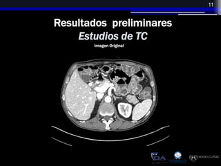 Reducción del ruido en imágenes de tomografía computarizada usando un filtro  bilateral anisotrópico