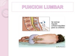 PUNCION LUMBAR