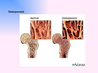 Osteoporosis 