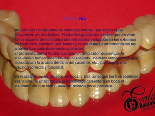 PRÓTESIS  FIJA son prótesis completamente dentosoportadas, que toman apoyo únicamente en los dientes. El odontólogo talla los dientes que servirán como soporte, denominados dientes pilares y situados en los extremos de cada zona edéntula (sin dientes), en los cuales irán cementadas las prótesis fijas cuidadosamente ajustadas . El protesista dental tendrá que usar un articulador que simule la articulación temporomandibular del paciente, modelos antagonistas que reproduzcan la arcada dentaria del paciente, etc., para lograr una oclusión correcta y funcional. Se realizarán varías pruebas en boca, y tras conseguir los tres objetivos esenciales de una prótesis, el odontólogo cementará en boca el resultado, sin que este pueda ser retirado por el paciente. 