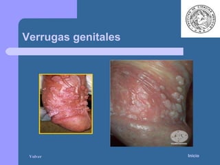 Verrugas genitales Inicio Volver 