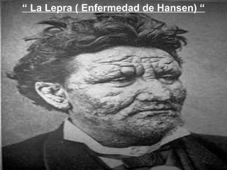 “ La Lepra ( Enfermedad de Hansen) “
 