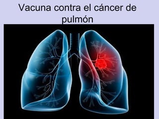 Vacuna contra el cáncer de
pulmón
 