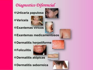 Diagnostico Diferencial
Urticaria papulosa
Varicela

Exantemas víricos
Exantemas medicamentosos
Dermatitis herpetiforme
Foliculitis
Dermatitis atópicas
Dermatitis seborreica

 