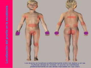 Localización del prurito en la escabiosis

 