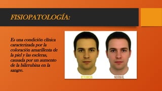 FISIOPATOLOGÍA:
Es una condición clínica
caracterizada por la
coloración amarillenta de
la piel y las escleras,
causada por un aumento
de la bilirrubina en la
sangre.
 