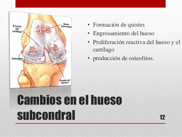 enfermedad articular degenerativa enfermedad articular degenerativa