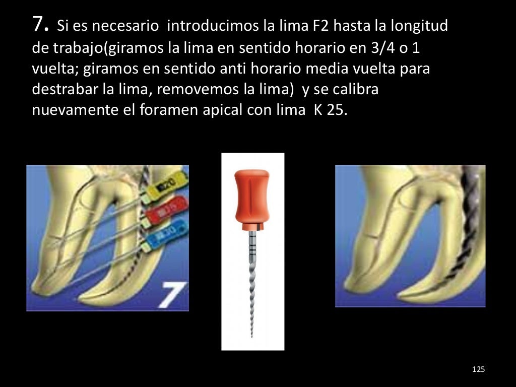 Historia de la endodoncia,tecnicas de preparacion