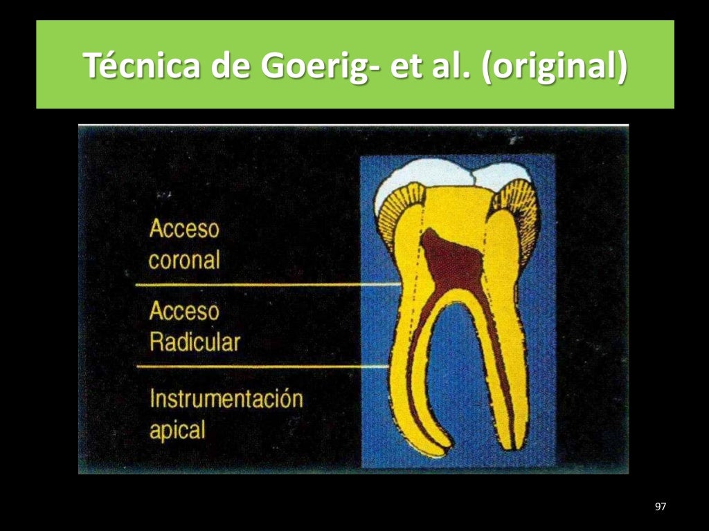 Historia de la endodoncia,tecnicas de preparacion