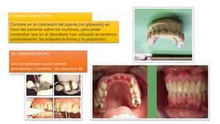 9.PRUEBA DE BISCOCHO
10. CEMENTACION PPF
Una vez glaseado nuestro puente
precedemos a Cementar con ionomero de
cementación
Consiste en la colocación del puente (no glaseado) en
boca del paciente sobre los muñones, para poder
comprobar que en el laboratorio han colocado la cerámica
correctamente. Se evaluará la forma y la proporción.
 