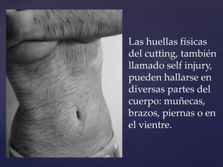 Las huellas físicas 
del cutting, también 
llamado self injury, 
pueden hallarse en 
diversas partes del 
cuerpo: muñecas, 
brazos, piernas o en 
el vientre. 
 