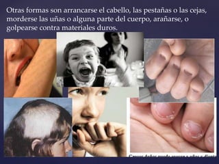 Otras formas son arrancarse el cabello, las pestañas o las cejas, 
morderse las uñas o alguna parte del cuerpo, arañarse, o 
golpearse contra materiales duros. 
 