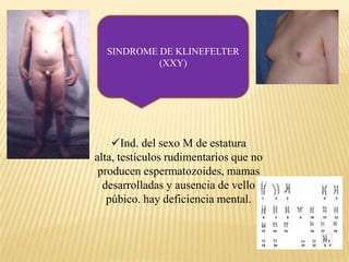 ANEUPLOIDIAS+:trisomiaSon alteraciones que afectan el numero total de cromosomas que recibe el cigoto. Pude ser un cromosoma que reciba de mas y en ese caso se le llama trisomia o que recibe un cromosoma  de menos y entonces se llamara monosomia.-:monosomia
