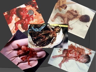 Presentación aborto