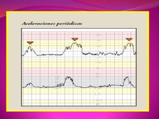 CLASIFICACIÓN: ACELERACIONES NO PERIODICAS