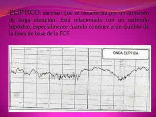 Para algunos autores las aceleraciones también tienen gradacionesAceleraciones espículas o espicas: 