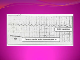Según  AladjenPresenta los siguientes  tipos de onda: • Omega: onda única o doble de escasa duración y que tiene buen pronóstico, su duración es de 15 segundos y con un incremento de 15 latidos por encima de la línea de base.