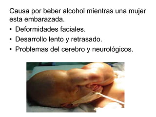 Causa por beber alcohol mientras una mujer
esta embarazada.
• Deformidades faciales.
• Desarrollo lento y retrasado.
• Problemas del cerebro y neurológicos.
 